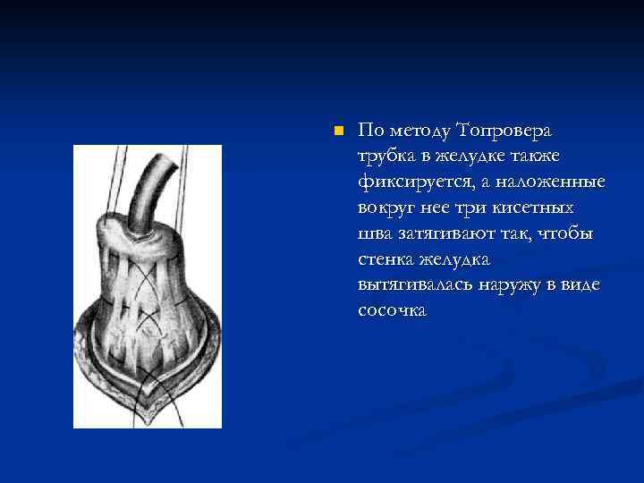 n По методу Топровера трубка в желудке также фиксируется, а наложенные вокруг нее три