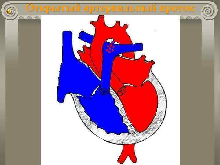 Открытый артериальный проток 