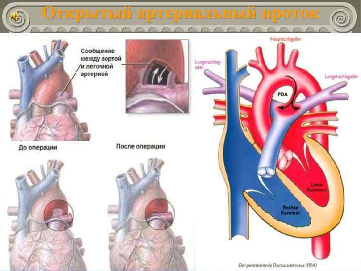 Открытый артериальный проток 