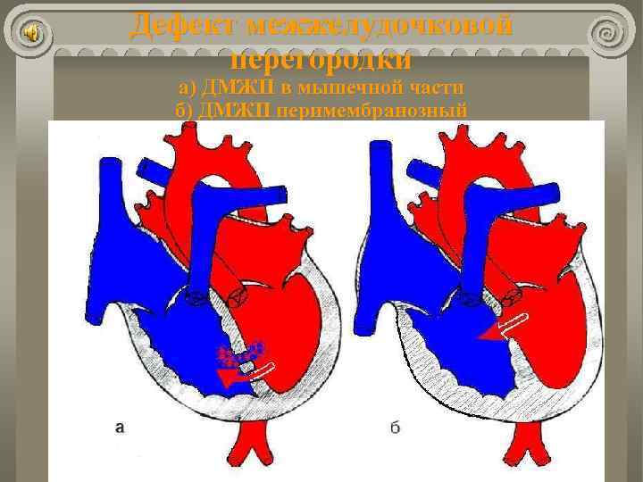 Дефект межжелудочковой перегородки а) ДМЖП в мышечной части б) ДМЖП перимембранозный 