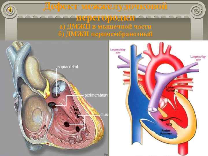 Дефект межжелудочковой перегородки а) ДМЖП в мышечной части б) ДМЖП перимембранозный 