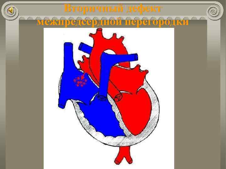 Вторичный дефект межпредсердной перегородки 