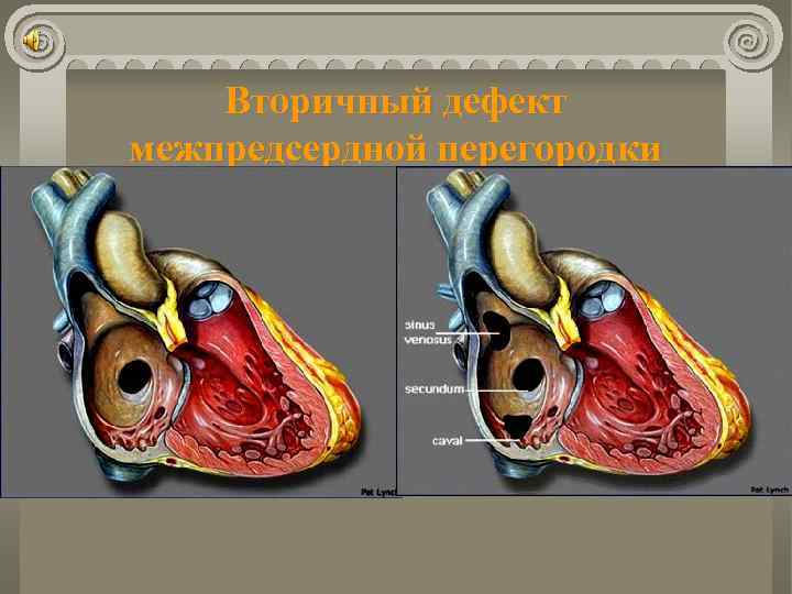 Вторичный дефект межпредсердной перегородки 