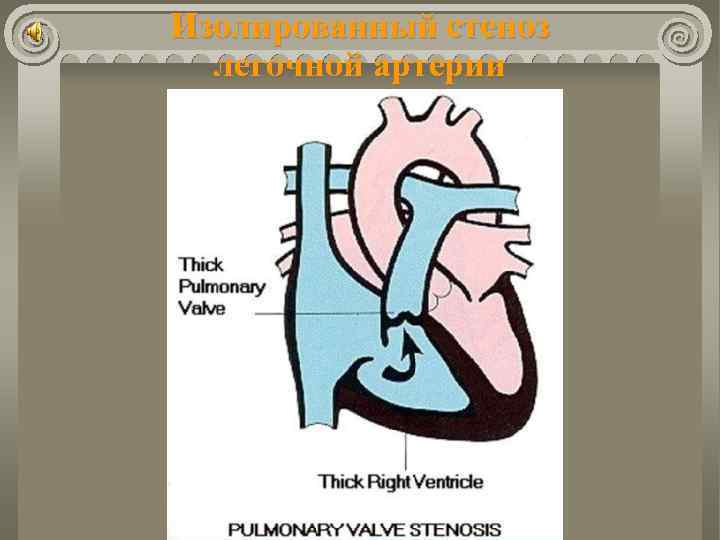 Изолированный стеноз легочной артерии 