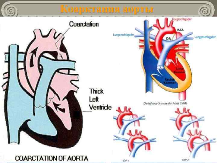 Коарктация аорты 