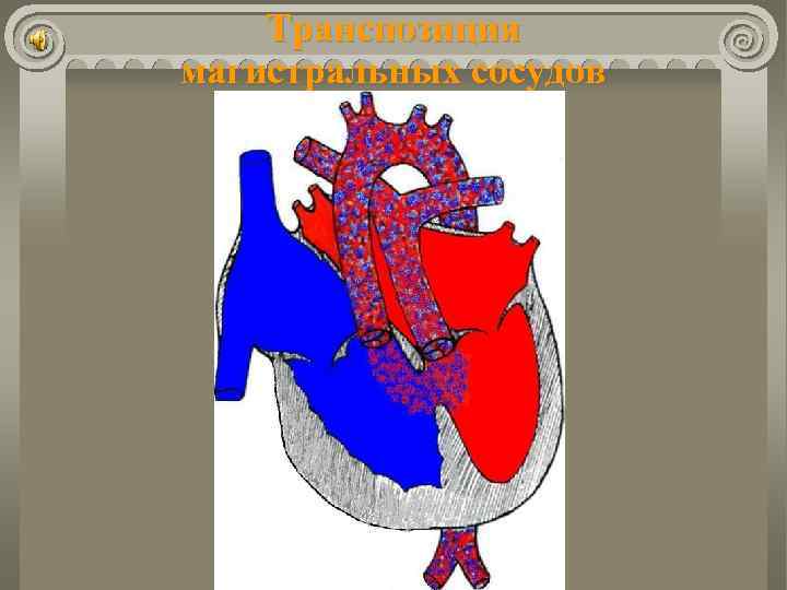 Транспозиция магистральных сосудов 