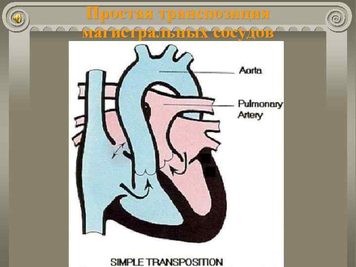 Простая транспозиция магистральных сосудов 