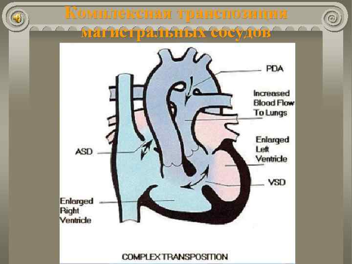 Комплексная транспозиция магистральных сосудов 