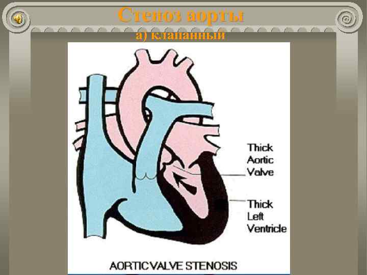 Стеноз аорты а) клапанный 