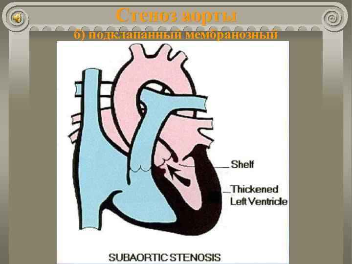 Стеноз аорты б) подклапанный мембранозный 