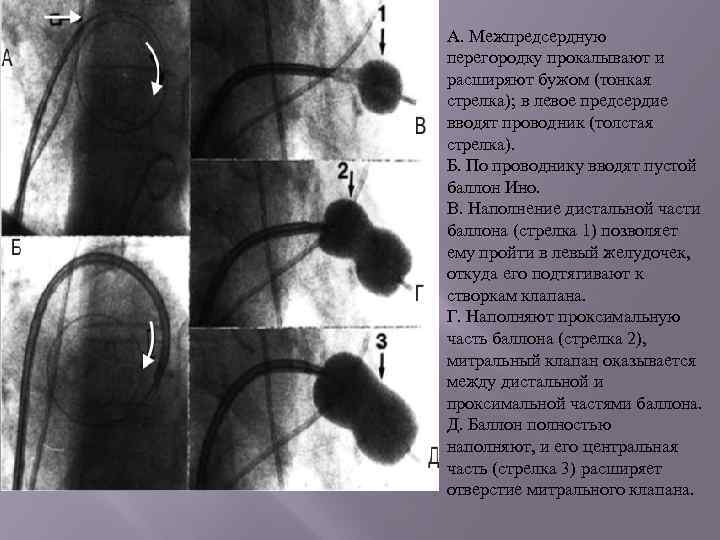 А. Межпредсердную перегородку прокалывают и расширяют бужом (тонкая стрелка); в левое предсердие вводят проводник