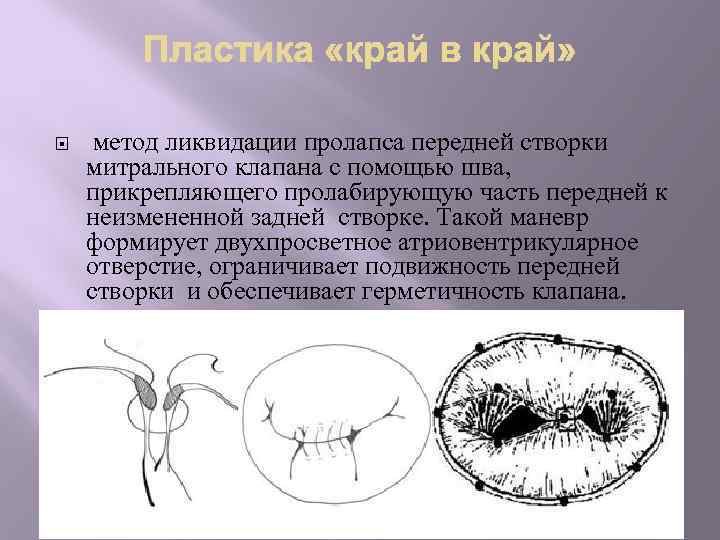  метод ликвидации пролапса передней створки митрального клапана с помощью шва, прикрепляющего пролабирующую часть