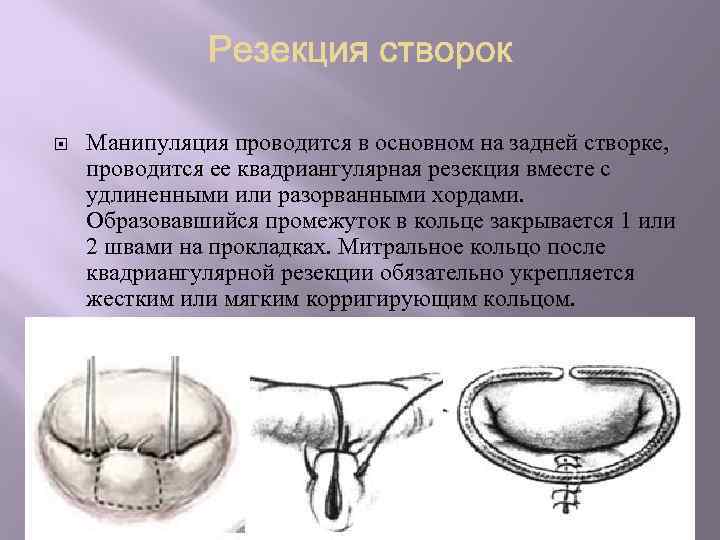  Манипуляция проводится в основном на задней створке, проводится ее квадриангулярная резекция вместе с