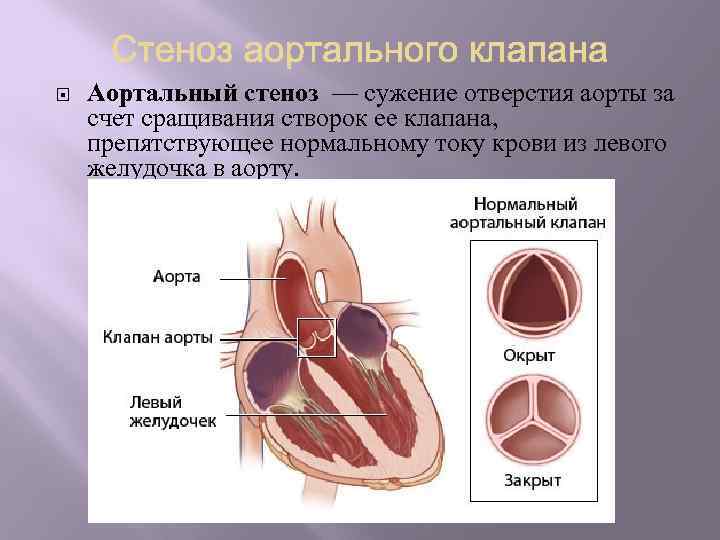  Аортальный стеноз — сужение отверстия аорты за счет сращивания створок ее клапана, препятствующее