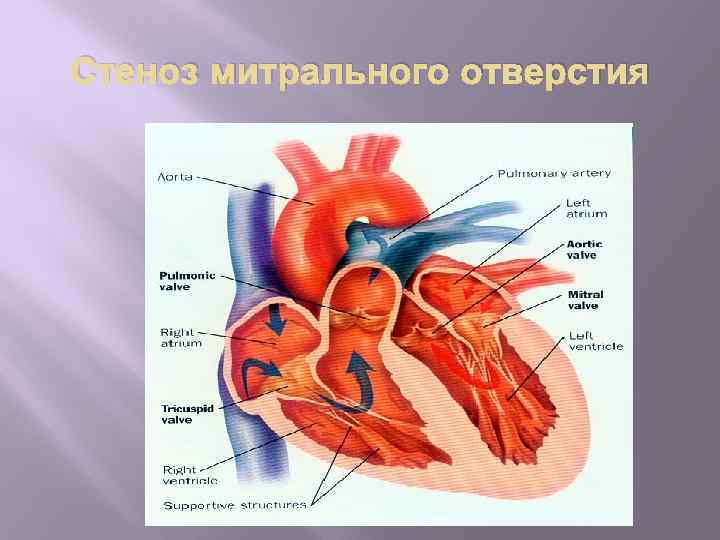 Стеноз митрального отверстия 