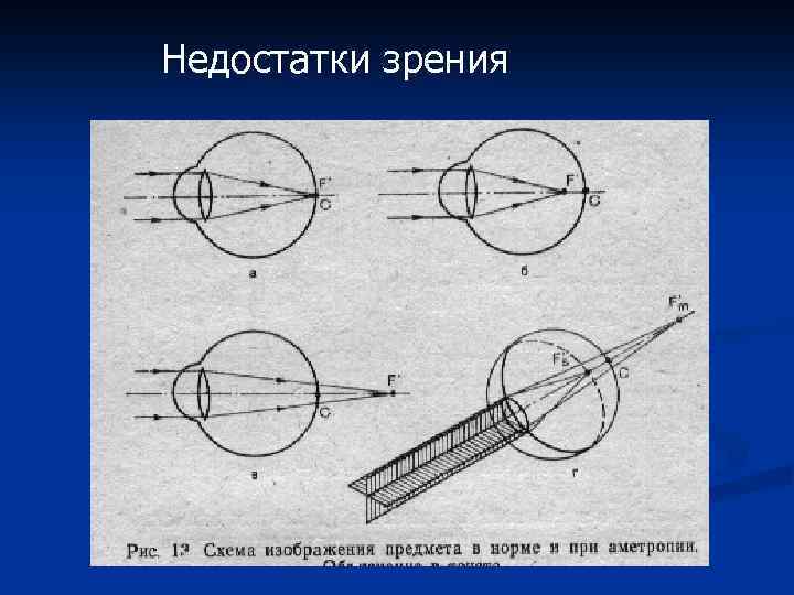 Недостатки зрения 