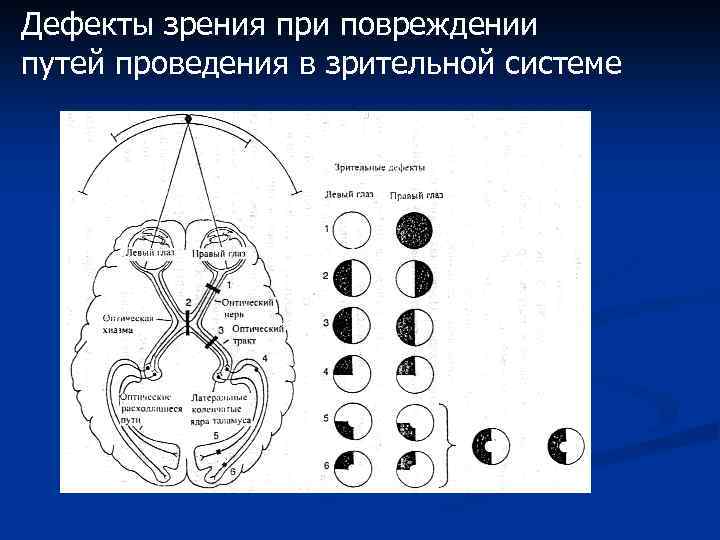 Дефекты зрения при повреждении путей проведения в зрительной системе 