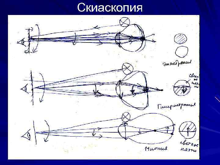 Скиаскопия 