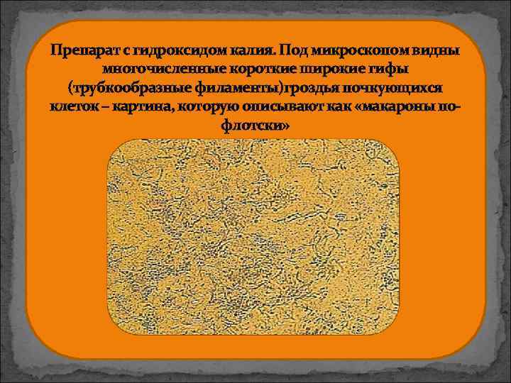 Препарат с гидроксидом калия. Под микроскопом видны многочисленные короткие широкие гифы (трубкообразные филаменты)гроздья почкующихся