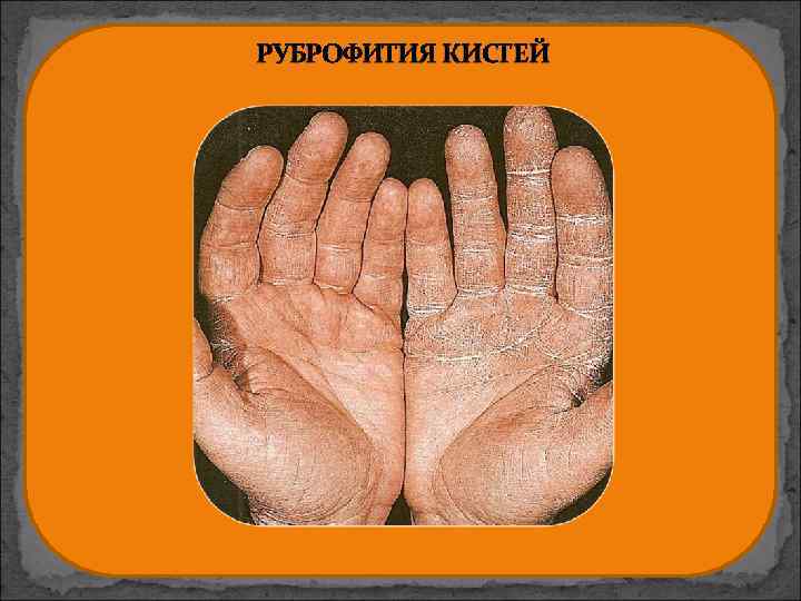 РУБРОФИТИЯ КИСТЕЙ 