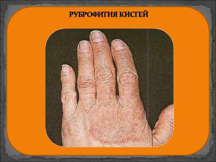 РУБРОФИТИЯ КИСТЕЙ 