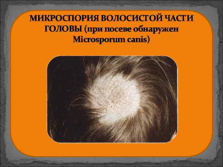 МИКРОСПОРИЯ ВОЛОСИСТОЙ ЧАСТИ ГОЛОВЫ (при посеве обнаружен Microsporum canis) 