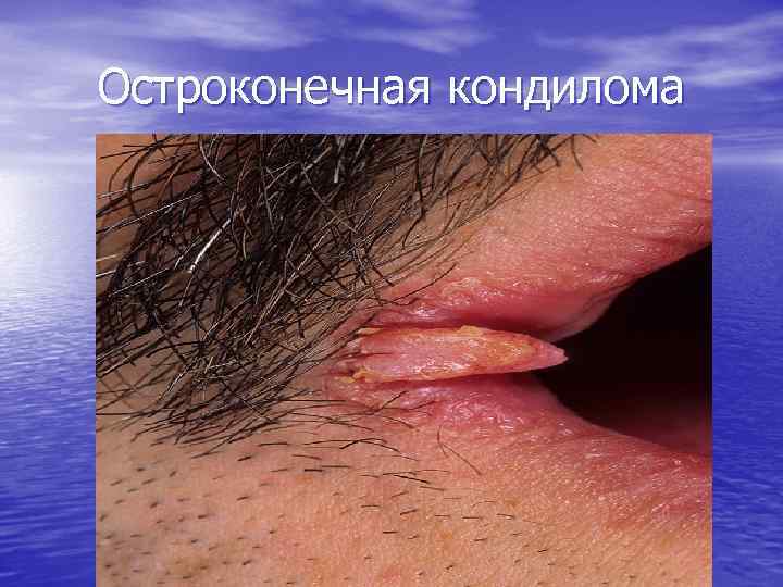 Остроконечная кондилома 