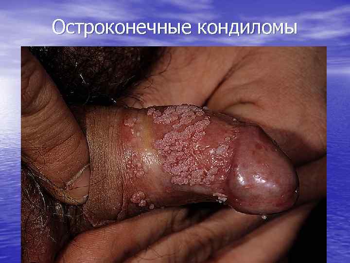 Остроконечные кондиломы 