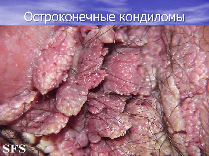 Остроконечные кондиломы 