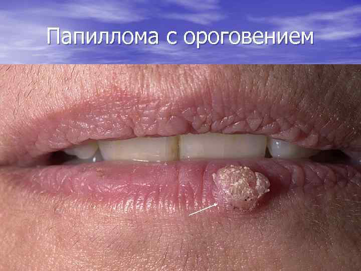 Папиллома с ороговением 