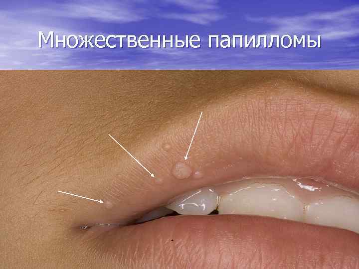 Множественные папилломы 