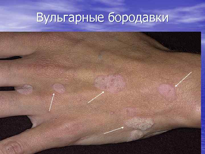 Вульгарные бородавки 