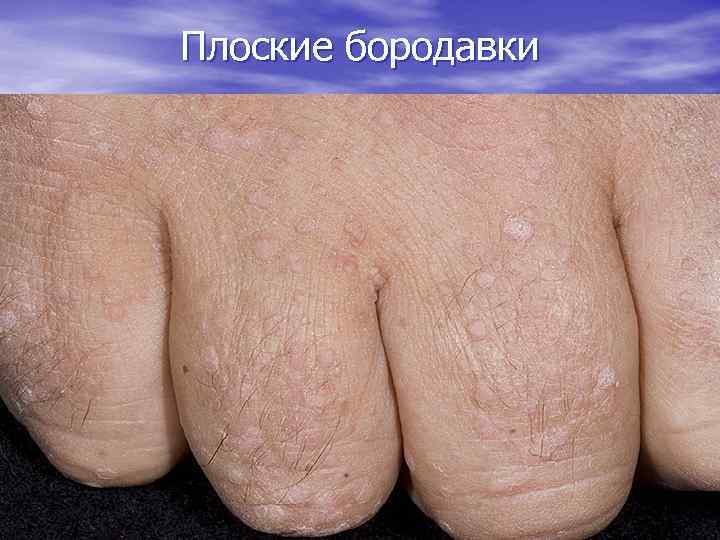 Плоские бородавки 