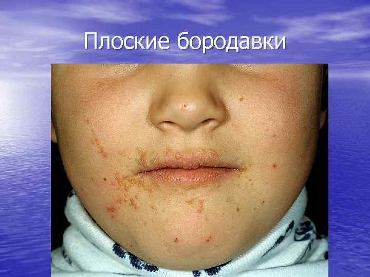 Плоские бородавки 