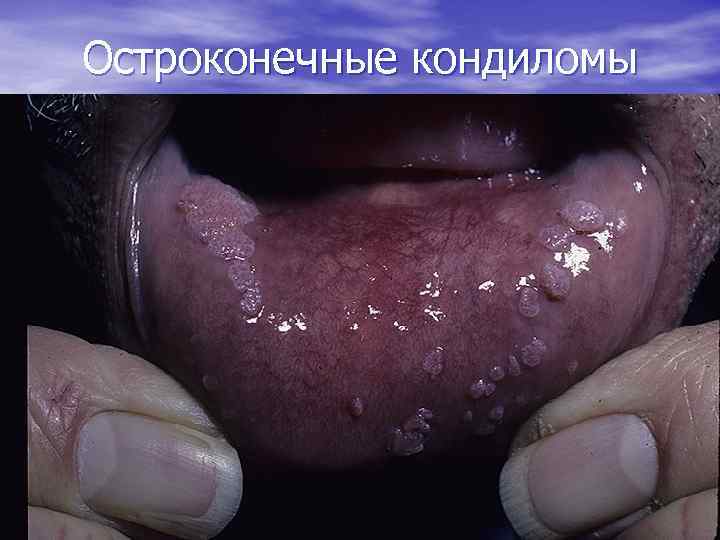 Остроконечные кондиломы 