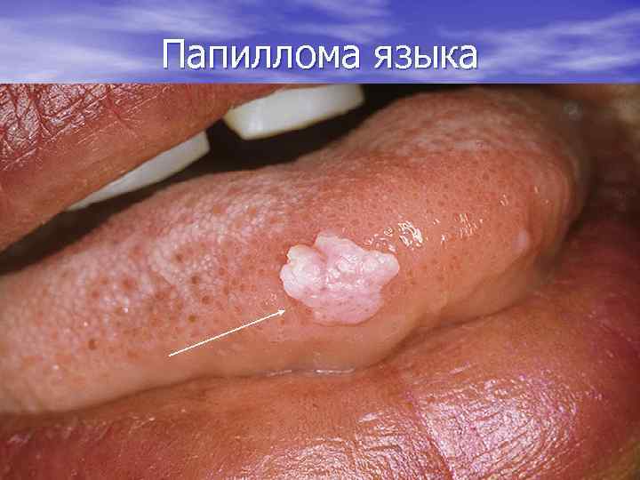 Папиллома языка 