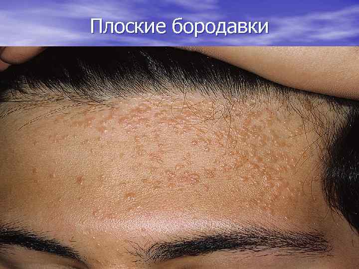 Плоские бородавки 