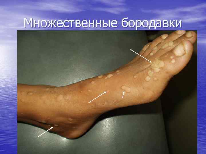 Множественные бородавки 