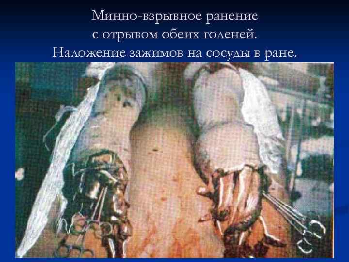Минно-взрывное ранение с отрывом обеих голеней. Наложение зажимов на сосуды в ране. 