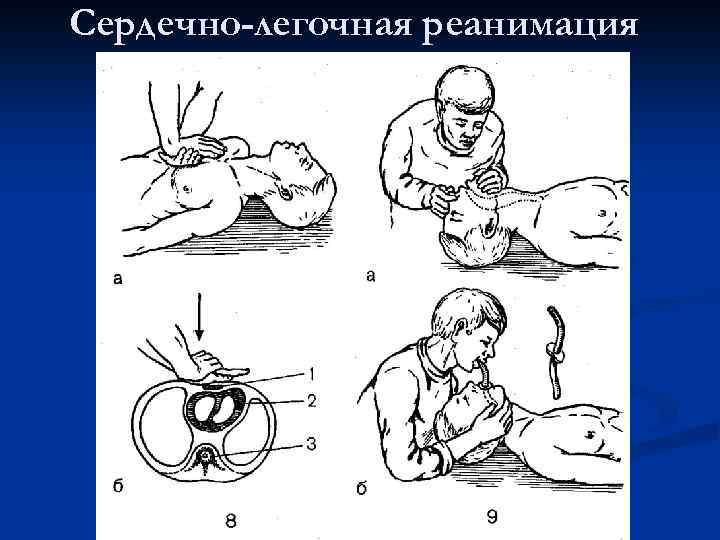 Сердечно-легочная реанимация 