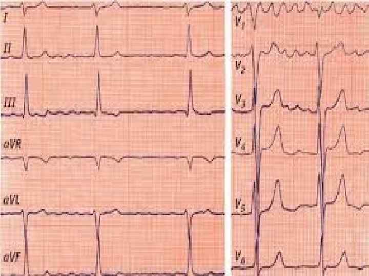 Кардиограмма при стенокардии фото