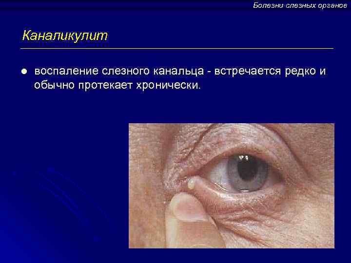 Болезни слезных органов Каналикулит l воспаление слезного канальца - встречается редко и обычно протекает