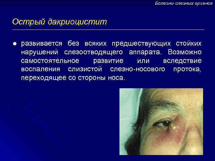 Болезни слезных органов Острый дакриоцистит l развивается без всяких предшествующих стойких нарушений слезоотводящего аппарата.