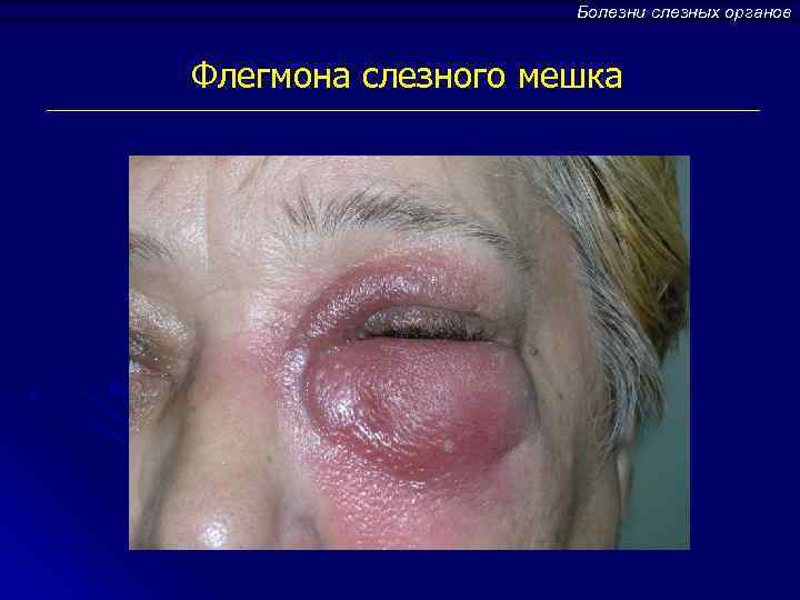 Болезни слезных органов Флегмона слезного мешка 