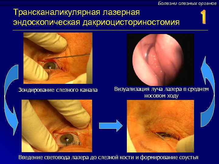 Болезни слезных органов Трансканаликулярная лазерная эндоскопическая дакриоцисториностомия Зондирование слезного канала Визуализация луча лазера в
