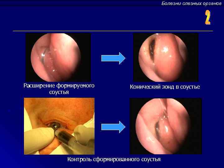 Болезни слезных органов Расширение формируемого соустья Конический зонд в соустье Контроль сформированного соустья 