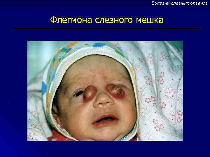 Болезни слезных органов Флегмона слезного мешка 