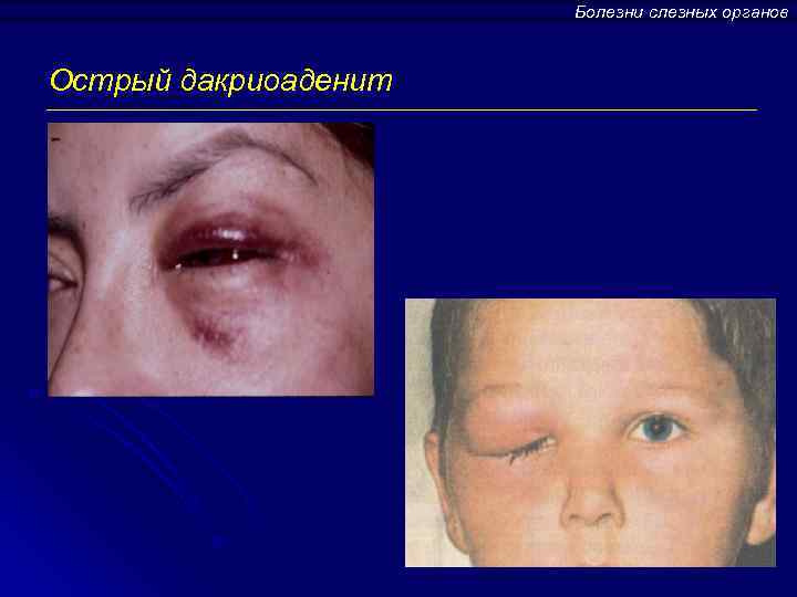 Болезни слезных органов Острый дакриоаденит 