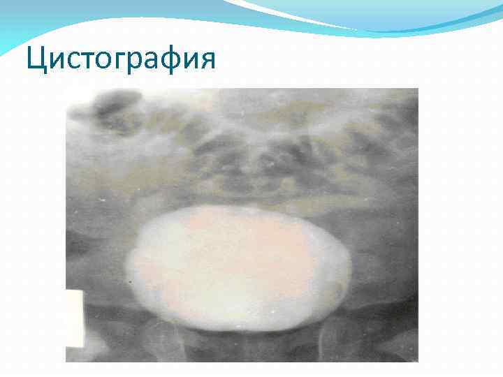 Цистография 