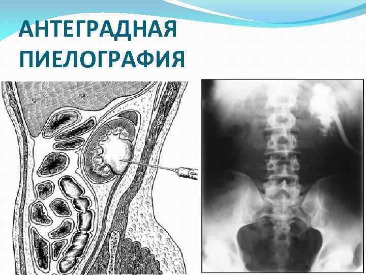 АНТЕГРАДНАЯ ПИЕЛОГРАФИЯ 